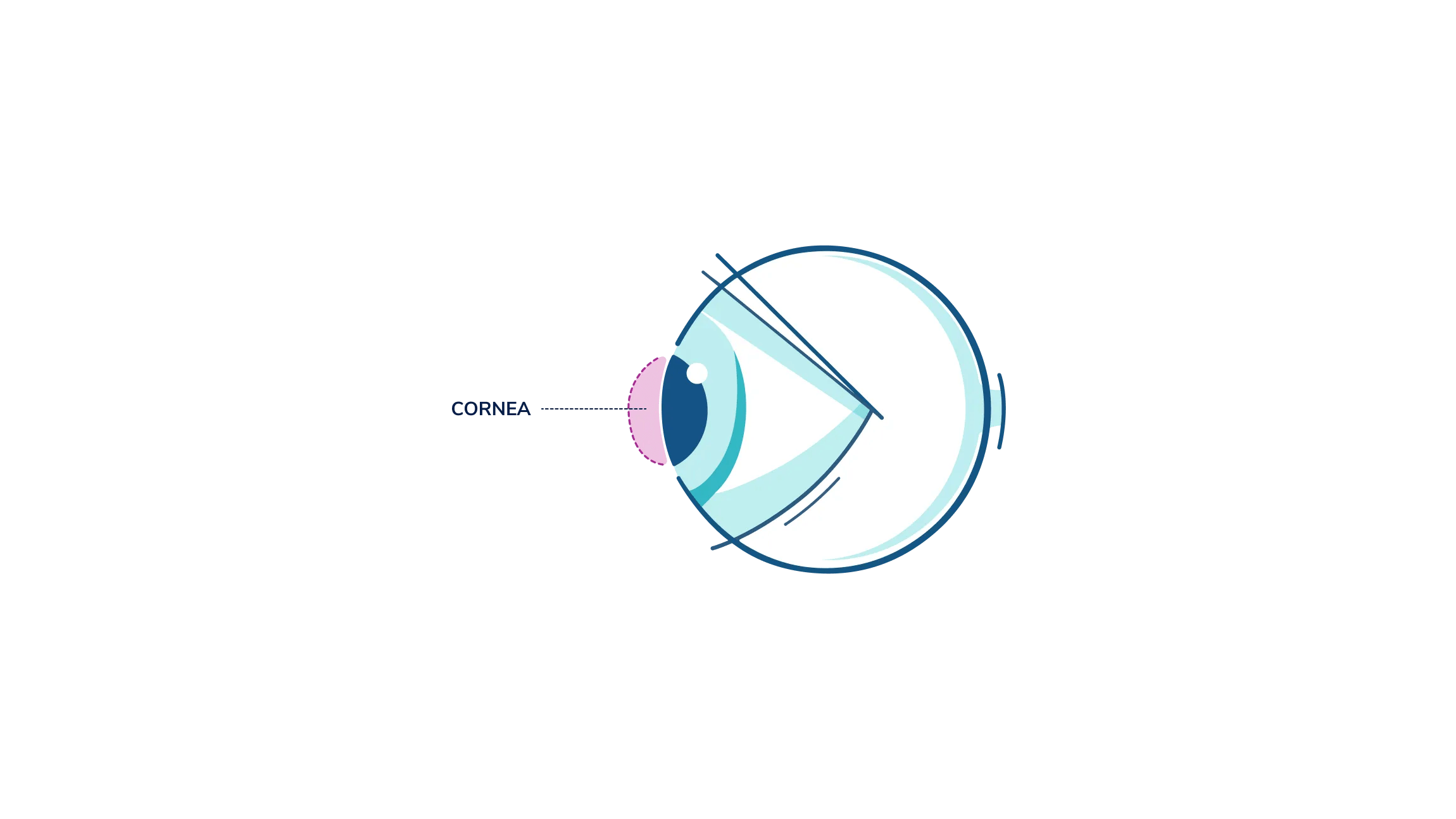 An illustration showing where the cornea is in the eye.