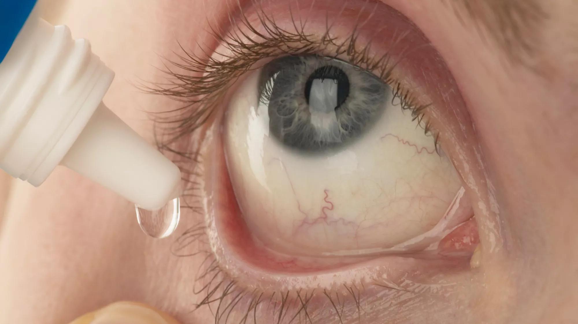 Eye Drop Use Close-Up