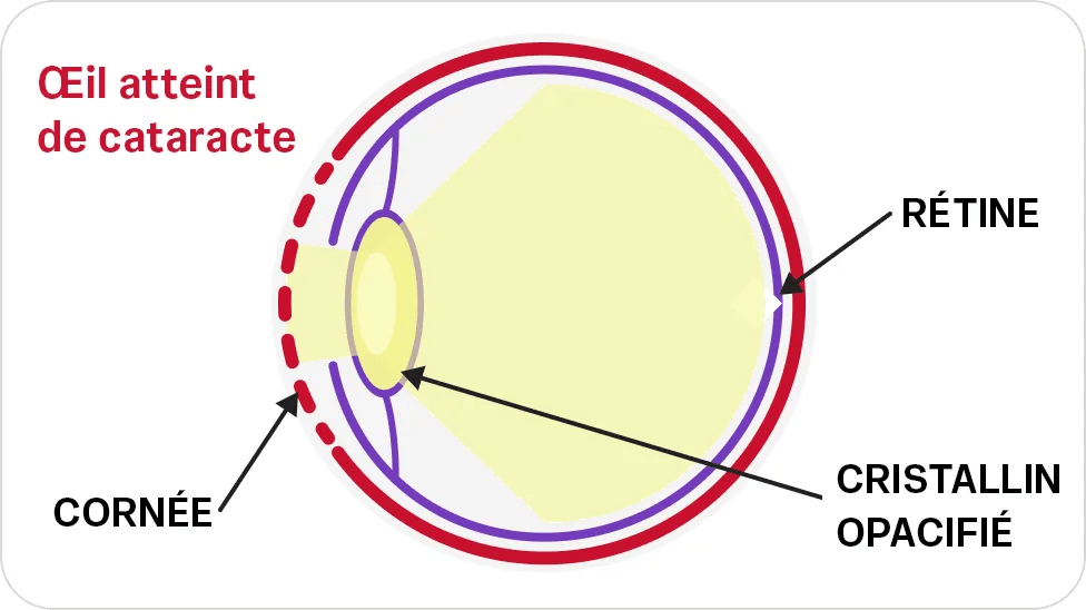 Œil atteint de cataracte