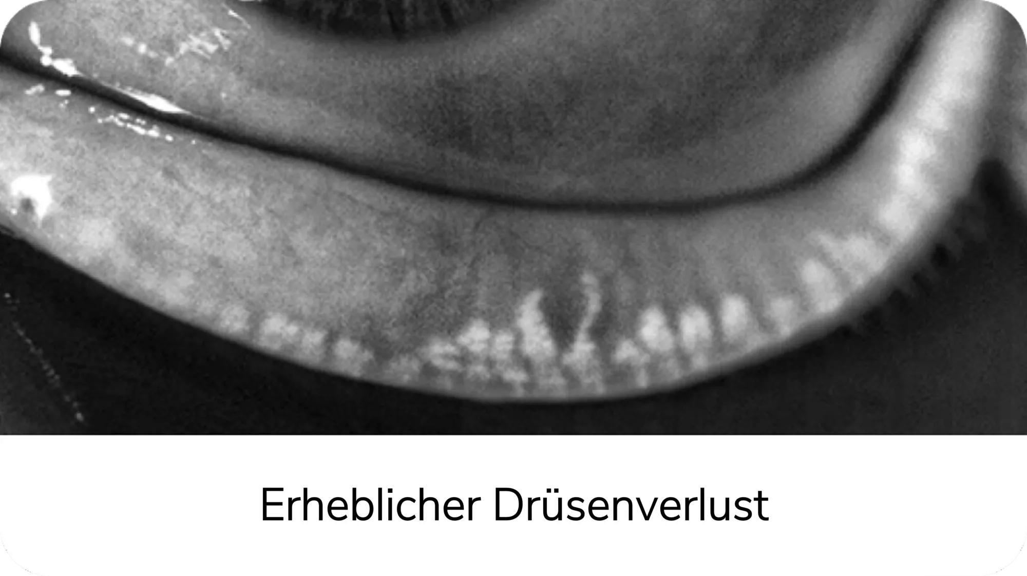 Erheblicher Drüsenverlust