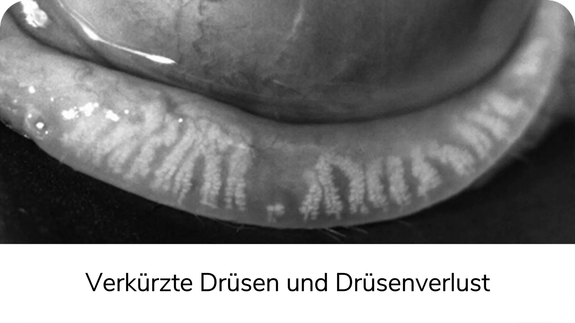 Verkürzte Drüsen und Drüsenverlust