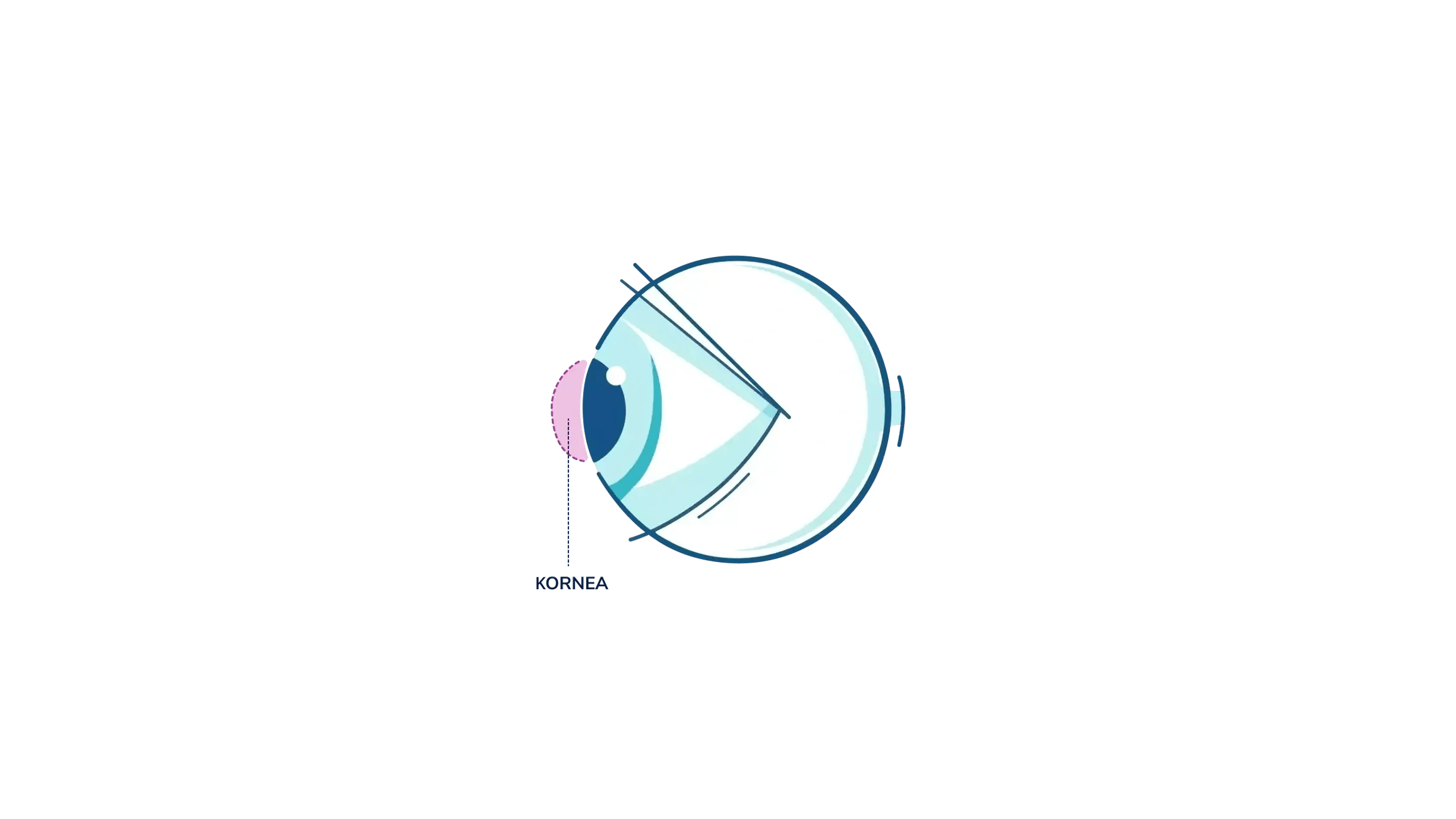 An illustration showing where the cornea is in the eye.