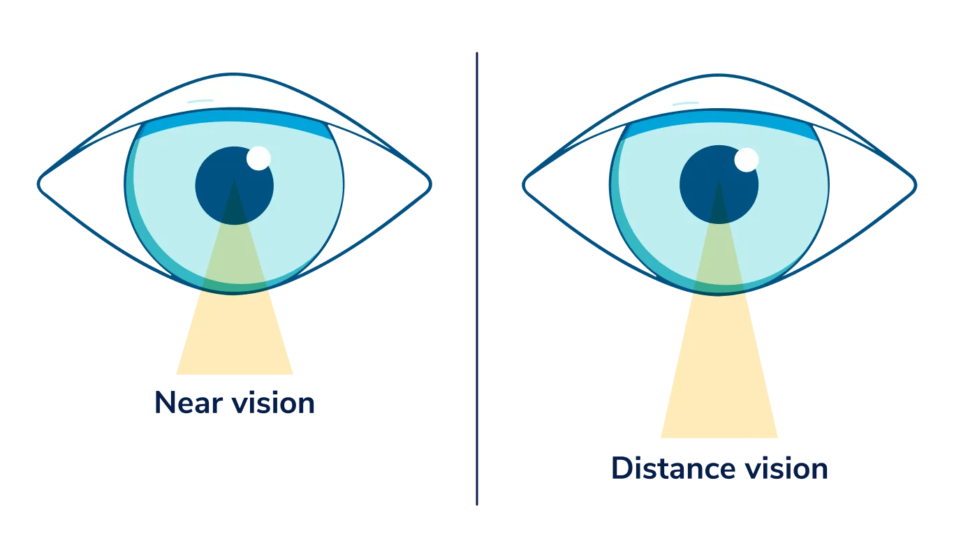 Illustration of one eye that is labeled "near vision" and one eye that is labeled "distance vision"