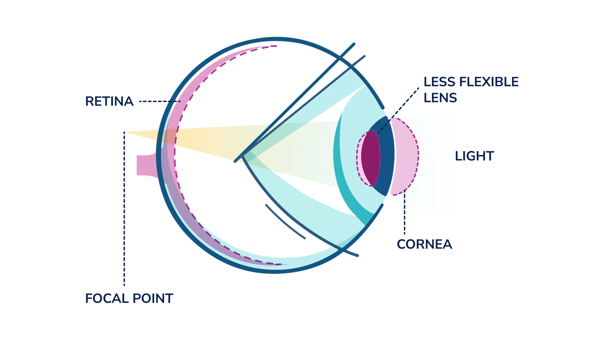 An illustration of a side view of an eye showing how light rays do not focus correctly when viewing things up close. 