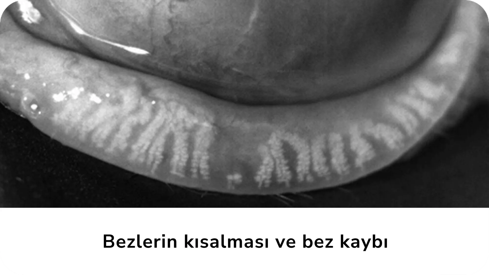 Bezlerin kısalması ve bez kaybı