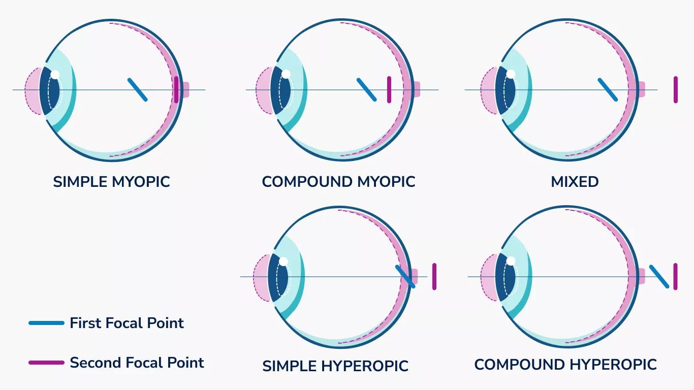 Five illustrated eyes show how two focal points from astigmatism can create different vision issues