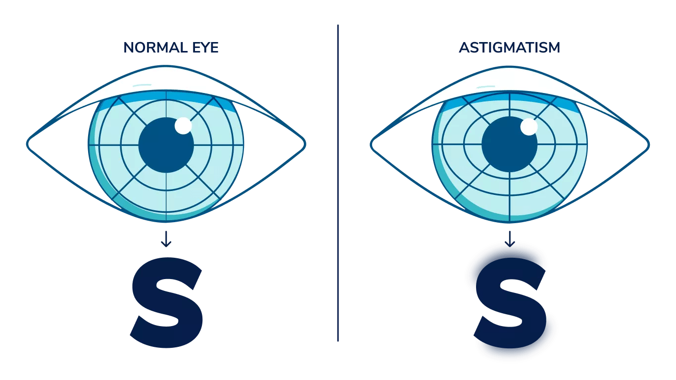 One illustrated eye shows a clear letter "s" while an illustrated astigmatic eye shows a blurry "s"