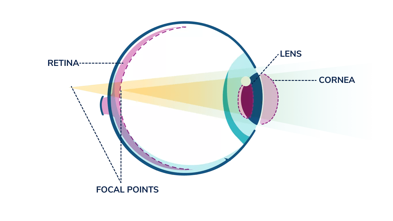 An illustrated side-view of an eye labeled with a few important parts shows how light focuses in a astigmatic eye