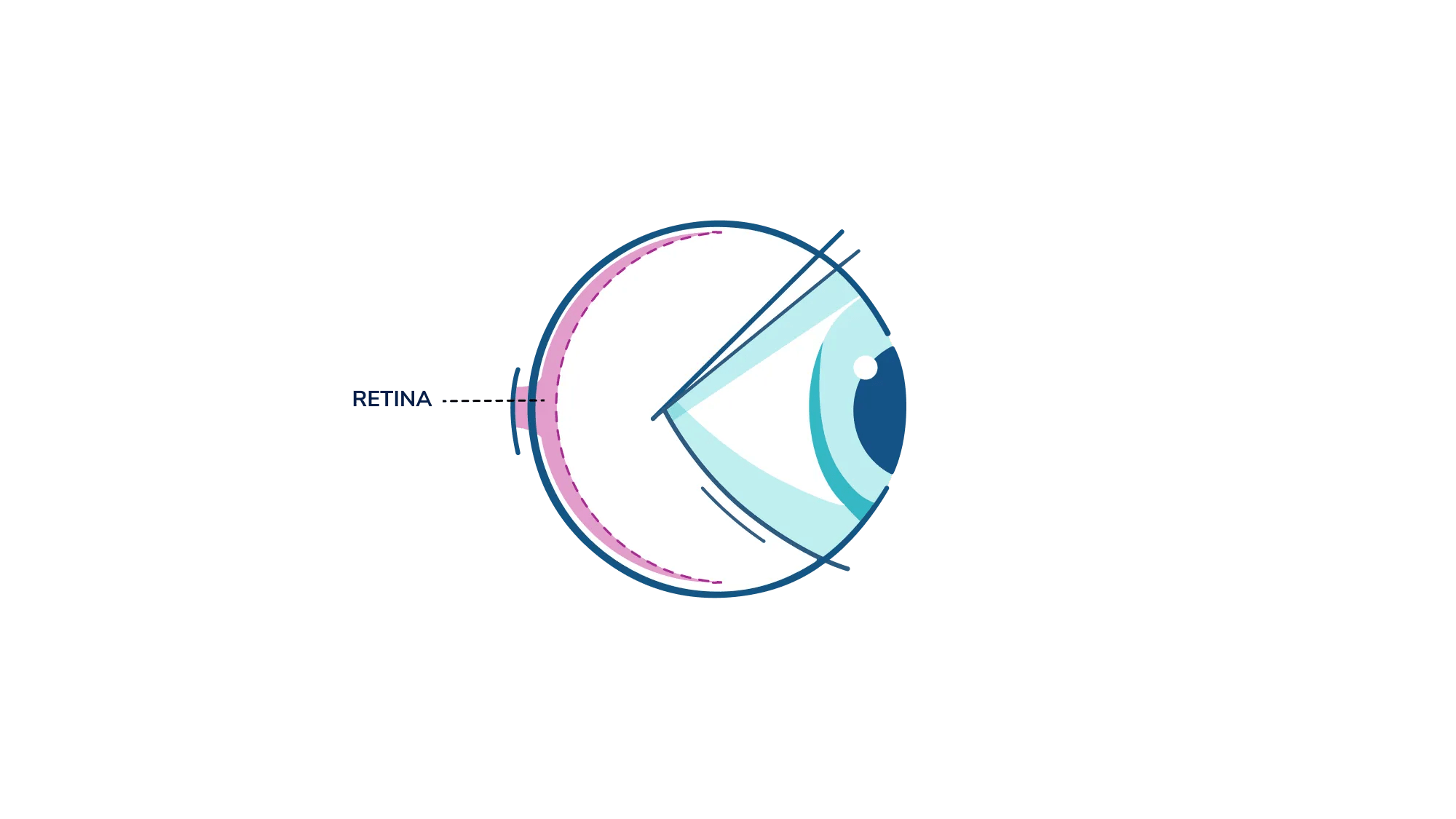 An illustration showing where the retina is in the eye.