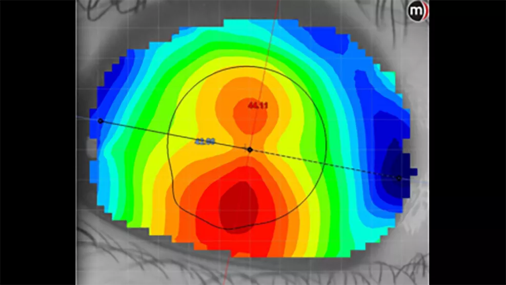 Topographic image characteristics of the retina in myopic eyes