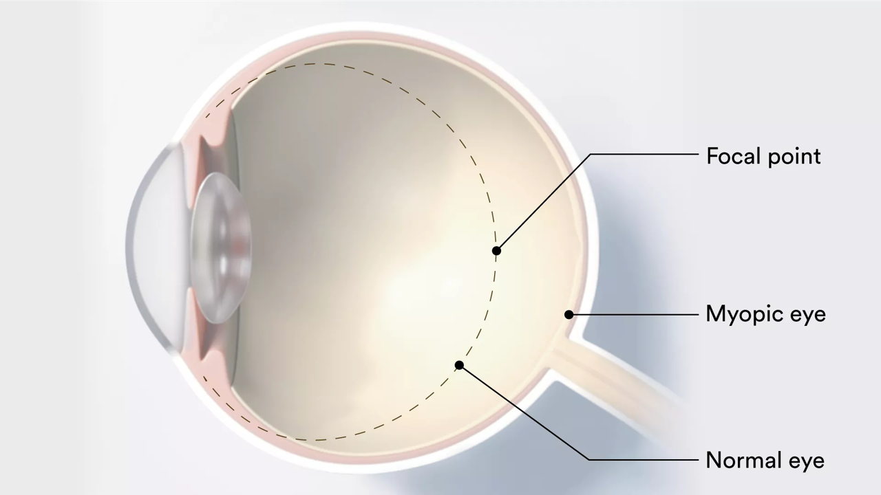 Abiliti_MM_CA_2D Eye Diagram-Patient Education Resources.