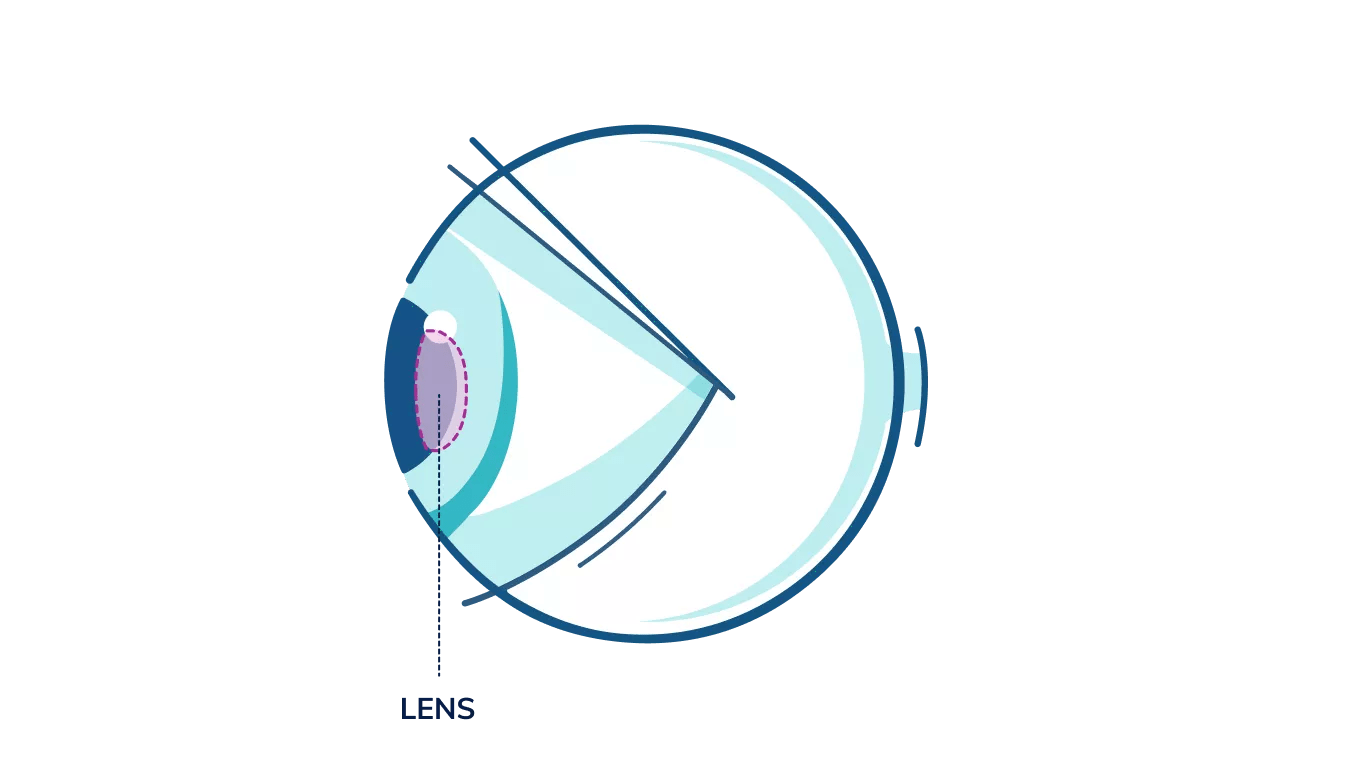 An illustration showing where the lens is in the eye.