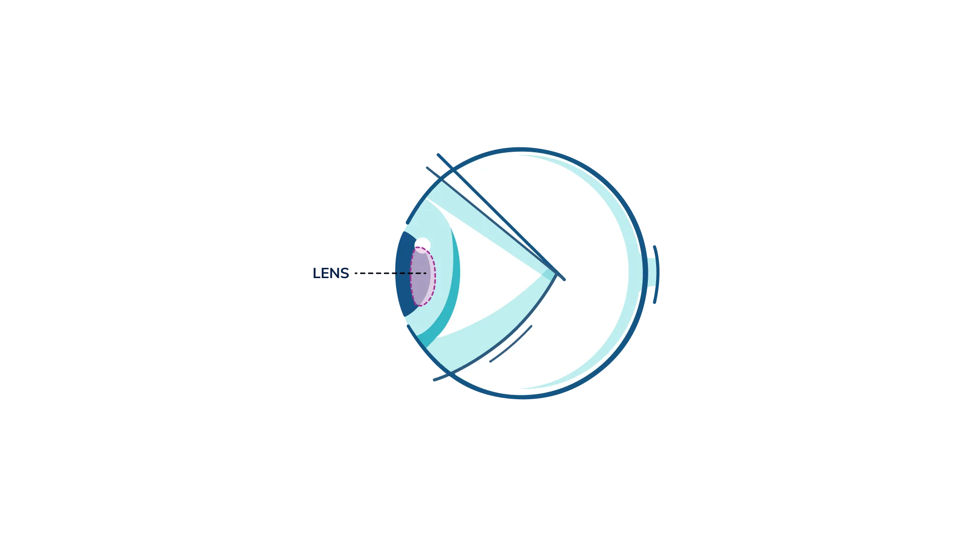 An illustration showing where the lens is in the eye.