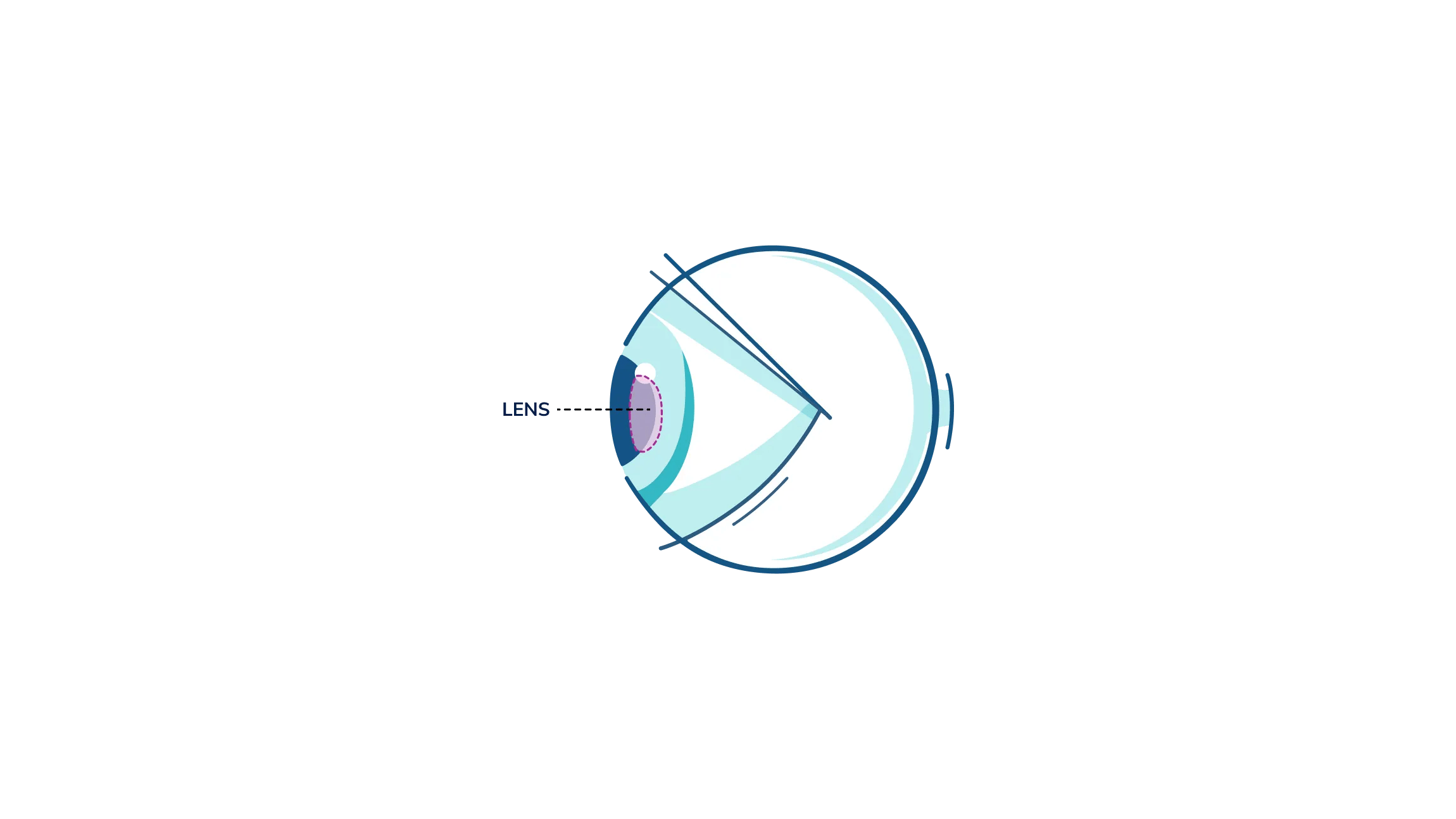 An illustration showing where the lens is in the eye.