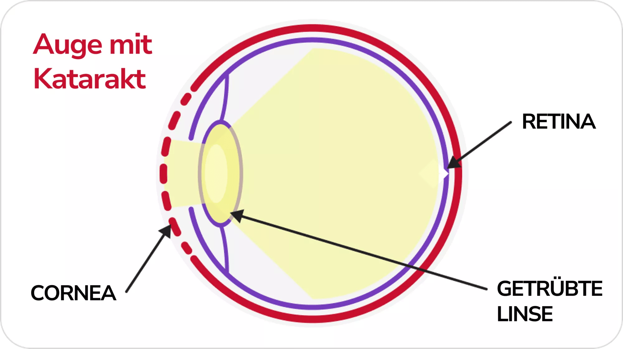 Auge mit Grauem Star