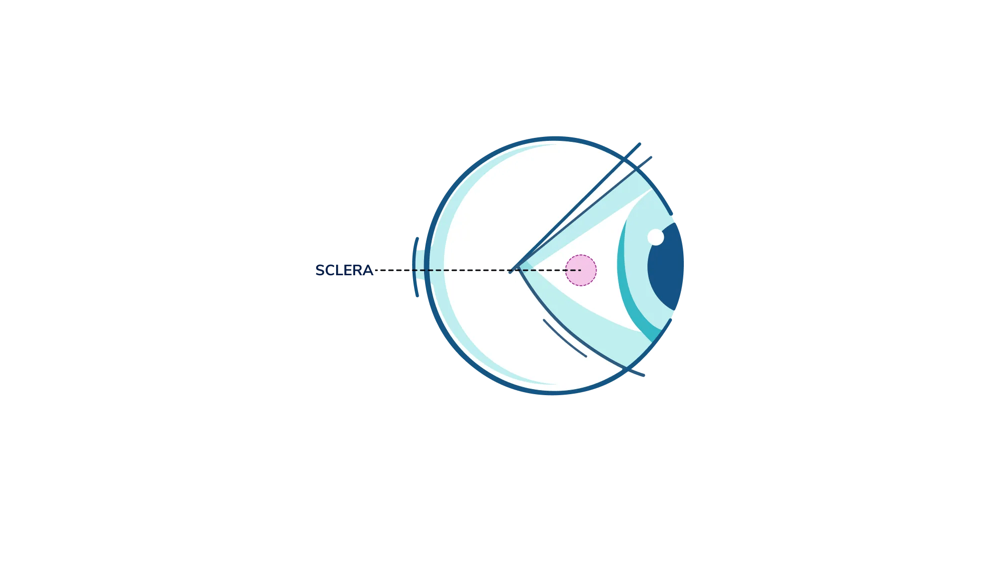 An illustration showing where the sclera is, in the eye.