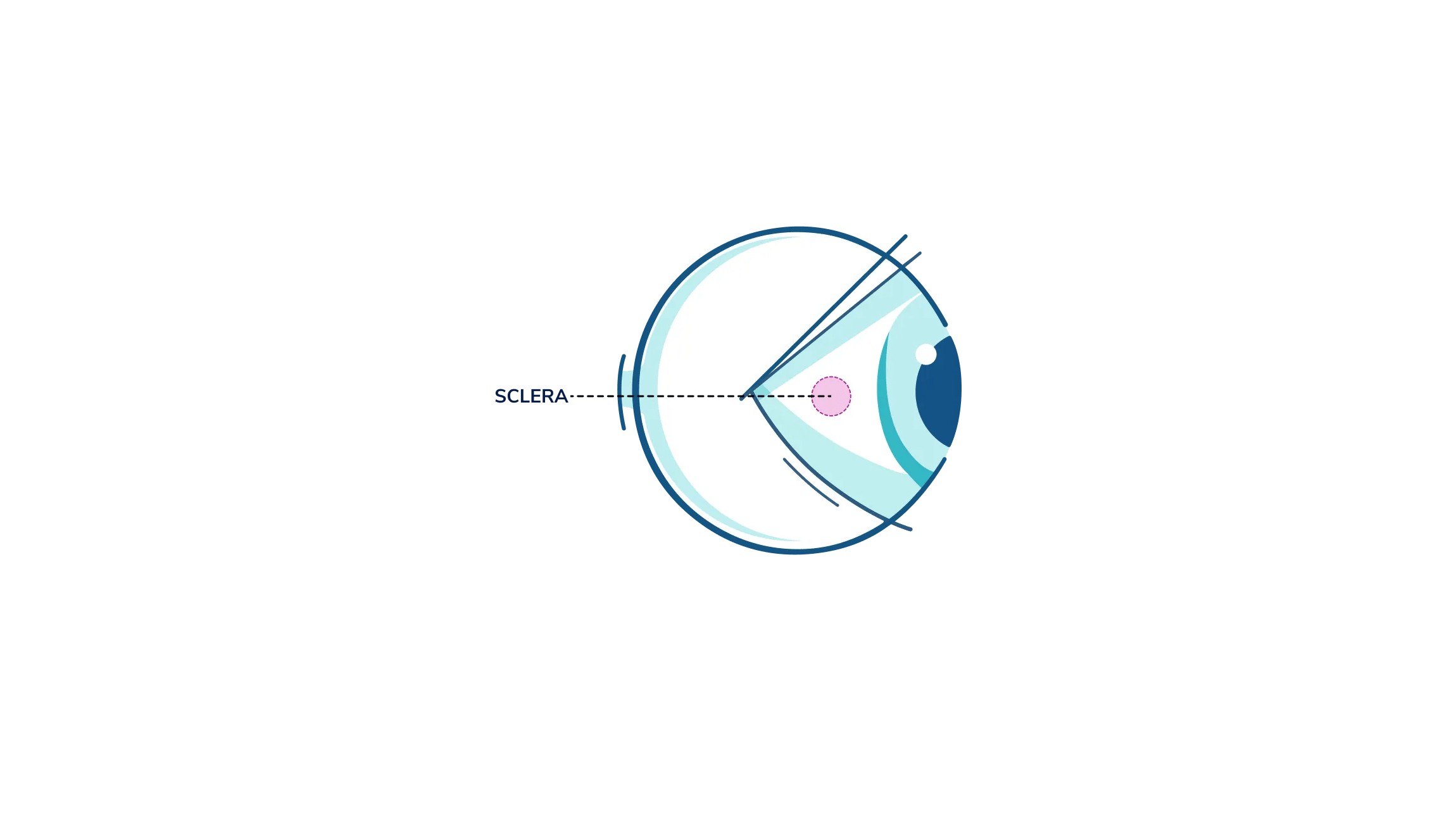 An illustration showing where the sclera is in the eye.