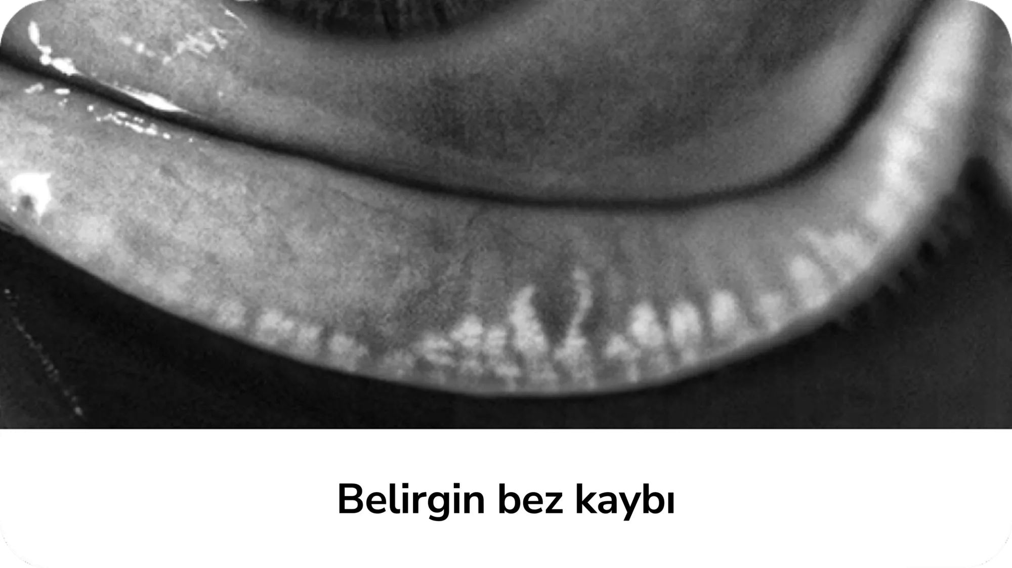 Belirgin bez kaybı 