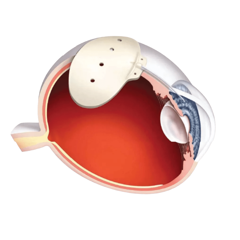 BAERVELDT Glaucoma Implants