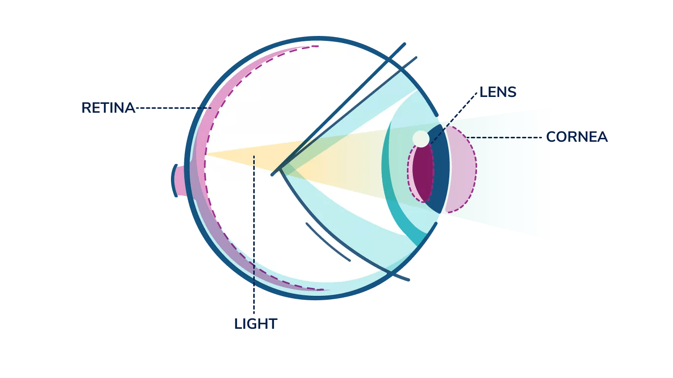 An illustrated side-view of an eye labeled with a few important parts shows how light focuses in a non-astigmatic eye