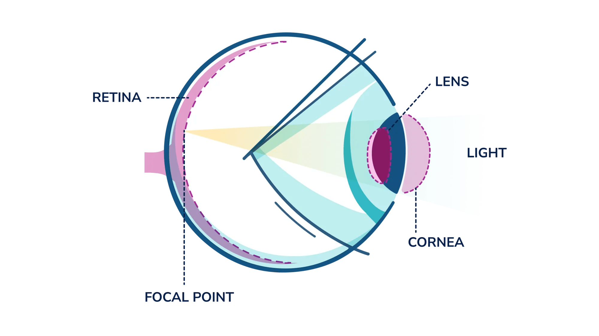 A side view illustration of a normal eye and how light focuses on the retina