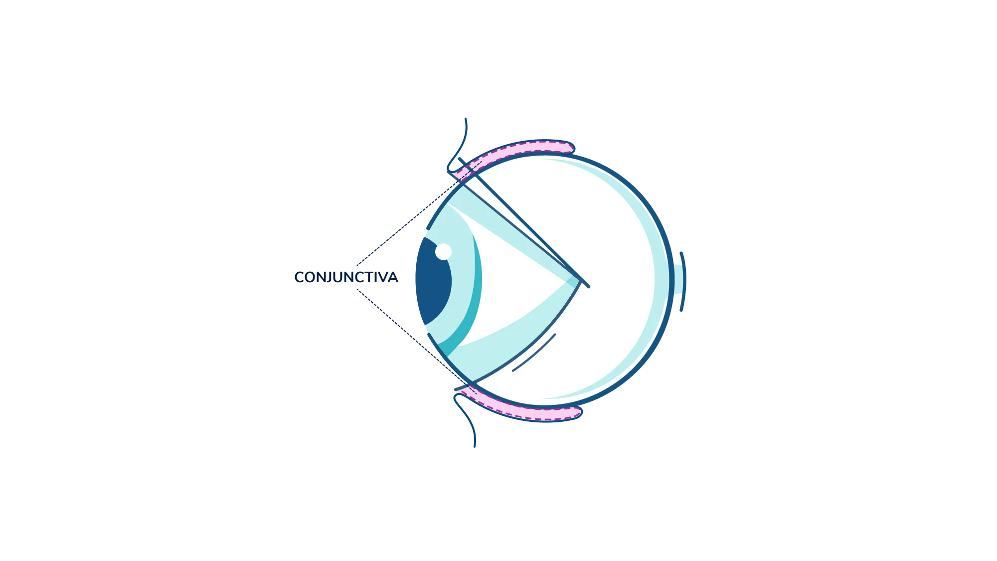 An illustration showing where the conjunctiva is in the eye.